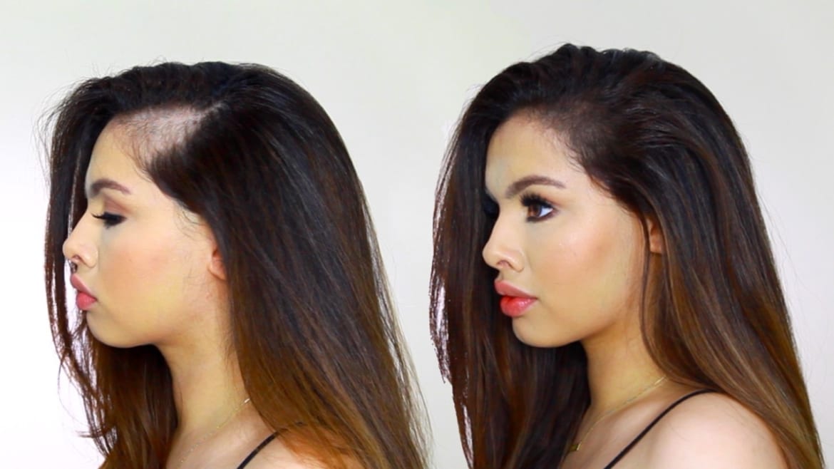 How is postpartum hair loss treated? - OrganiGrowHairCo