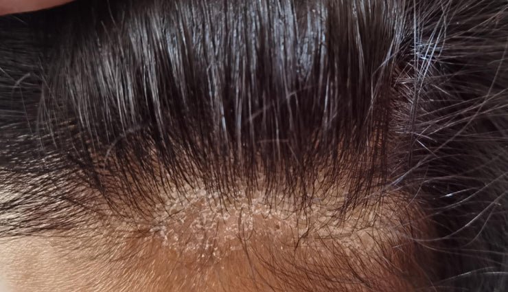 5 Reasons You Should Tone Your Scalp - OrganiGrowHairCo