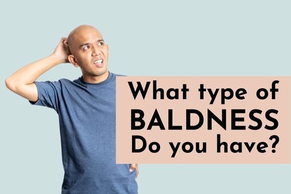 Types and Causes of Baldness - OrganiGrowHairCo