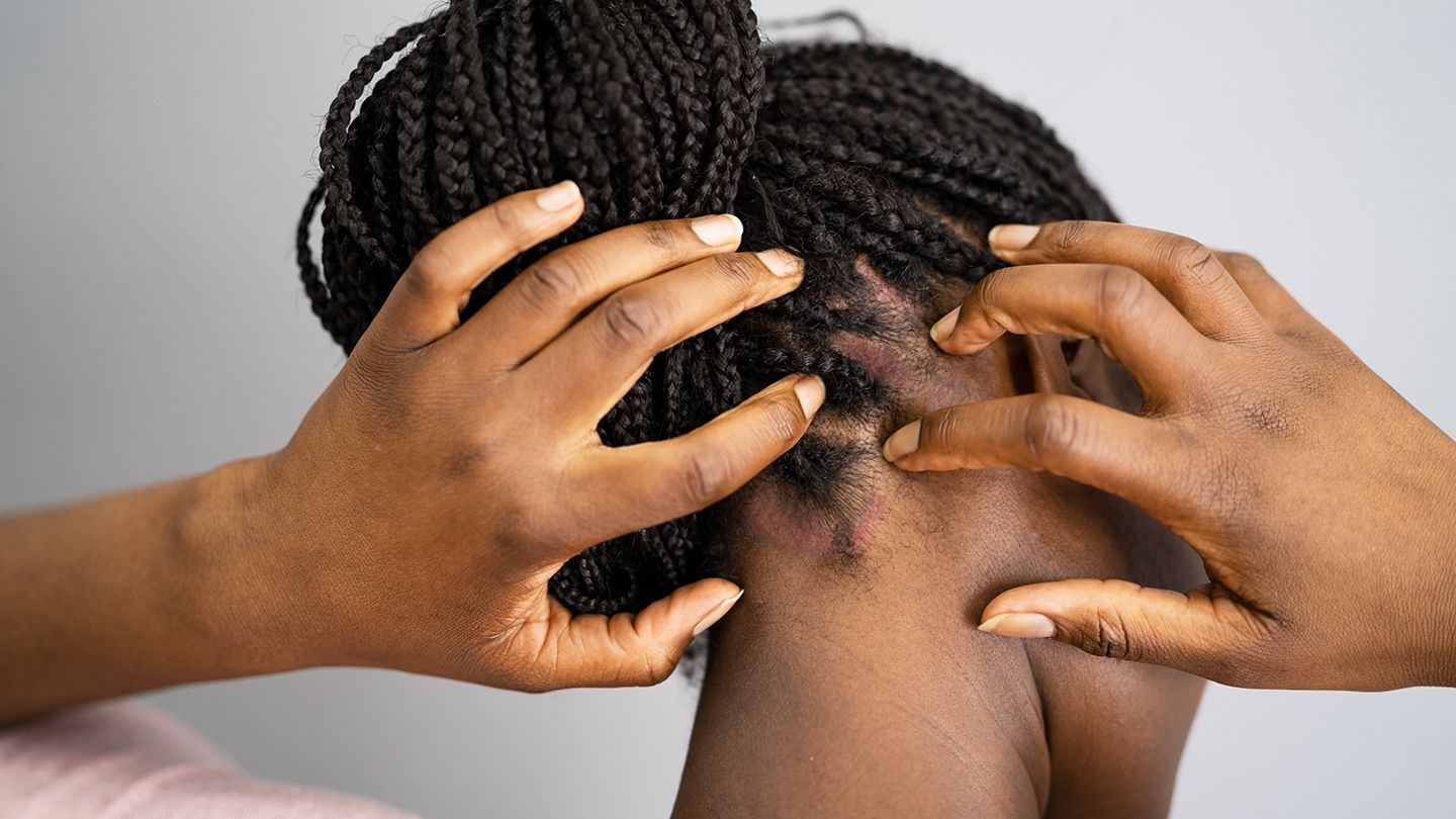 Dandruff, Psoriasis, Scalp Issues