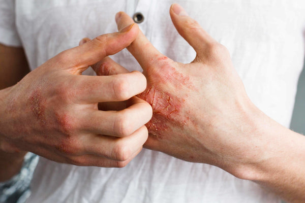 Eczema, Itching For A Solution - OrganiGrowHairCo