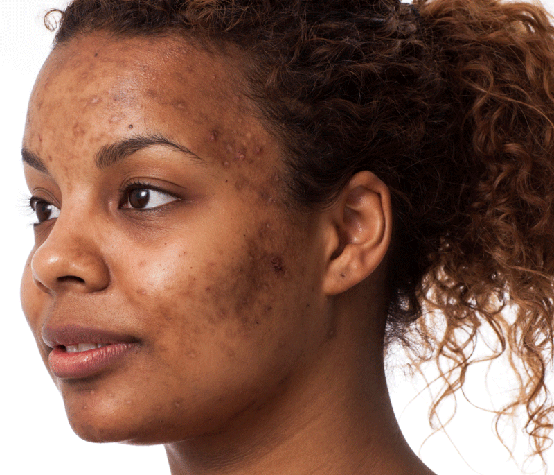 Hyperpigmentation