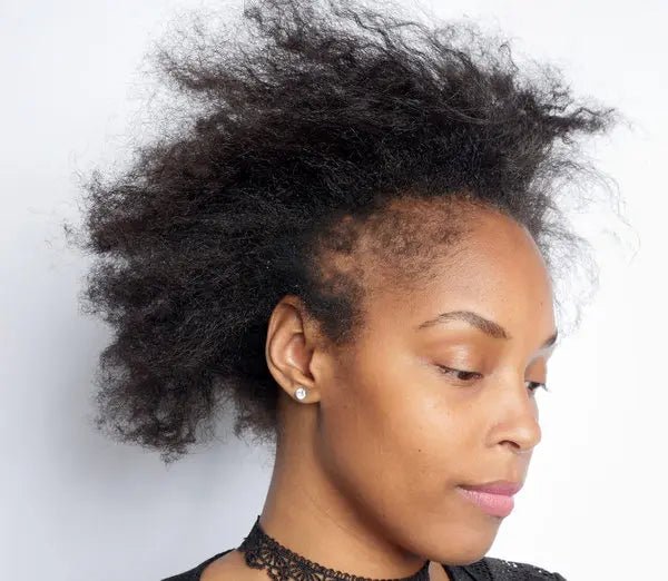 Navigating Alopecia in the Black Community: Understanding and Support - OrganiGrowHairCo