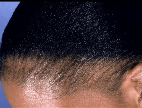 What is Alopecia? - OrganiGrowHairCo