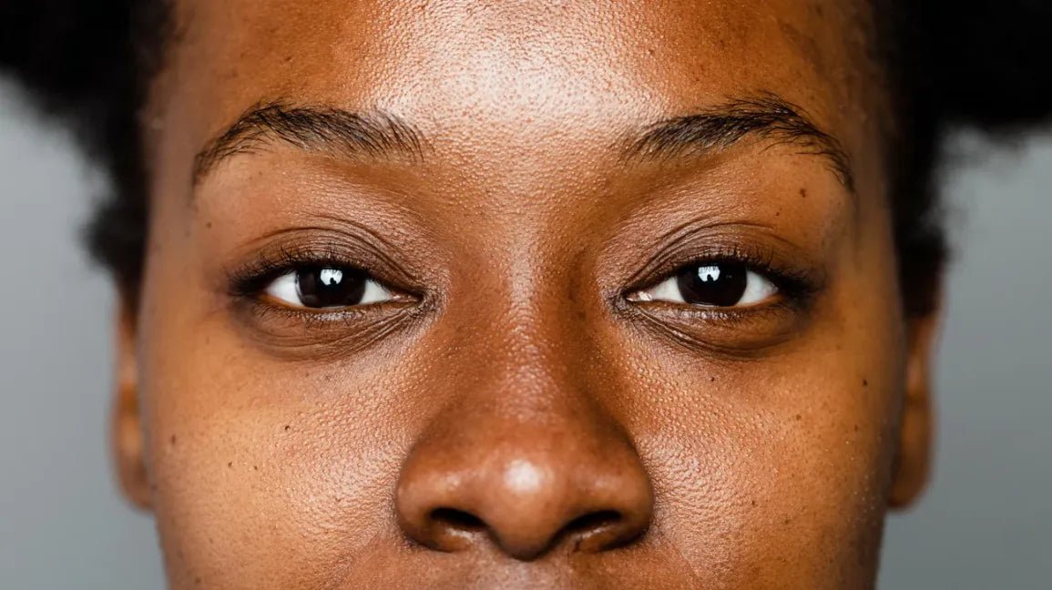 What is hyperpigmentation? - OrganiGrowHairCo
