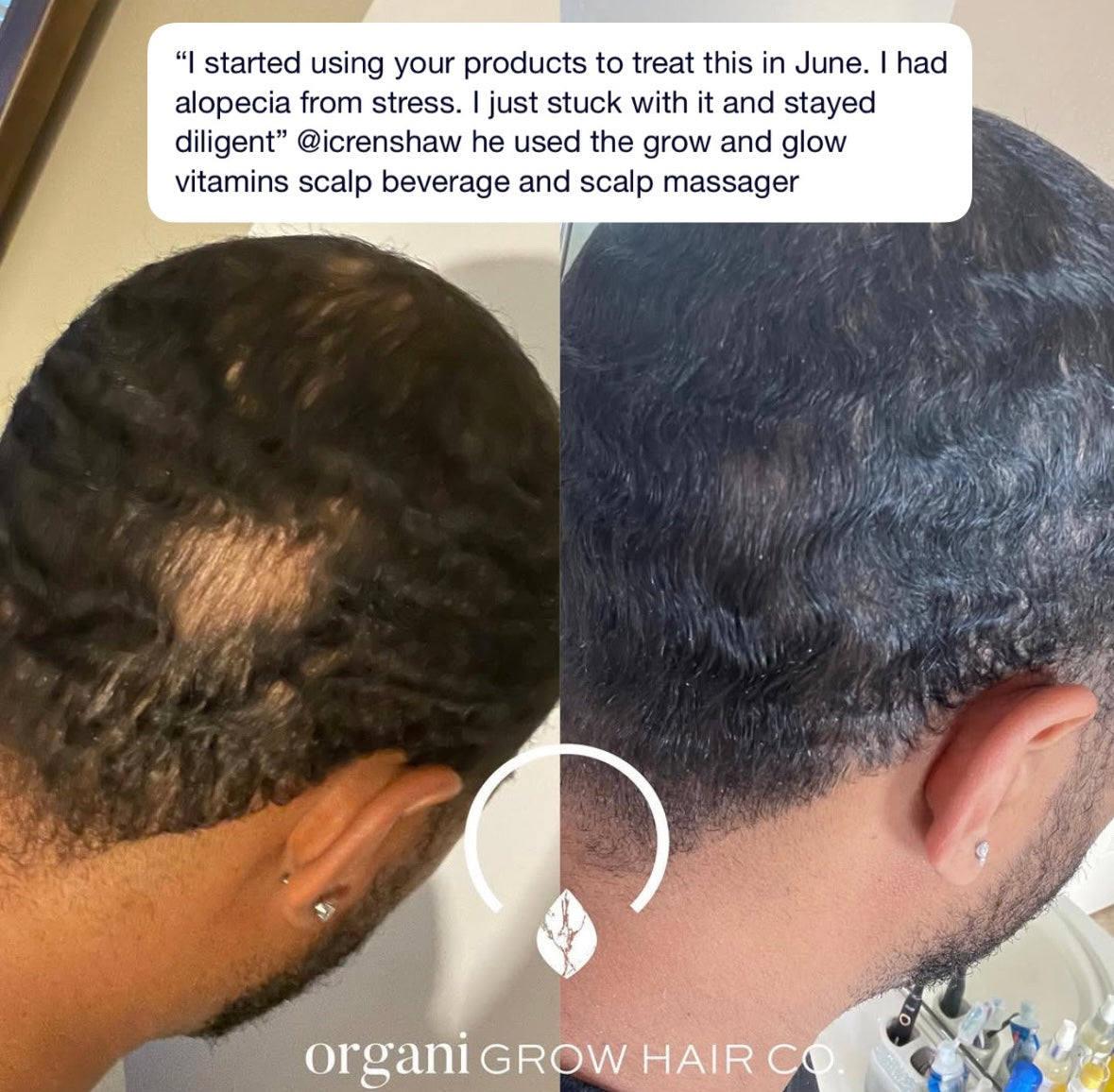 Male Balding Pack
