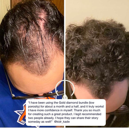 Male Balding Pack