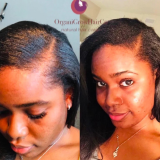 Before and after images of hair loss recovery from postpartum shedding and heat damage