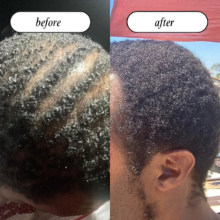 Hairline and crown regrowth before and after using non-toxic hair products