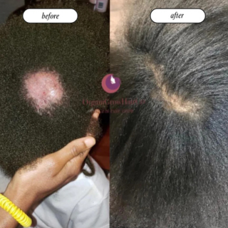 Alopecia recovery and scalp regrowth results with low porosity hair system