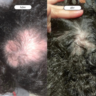 Alopecia recovery and scalp regrowth results with low porosity hair system